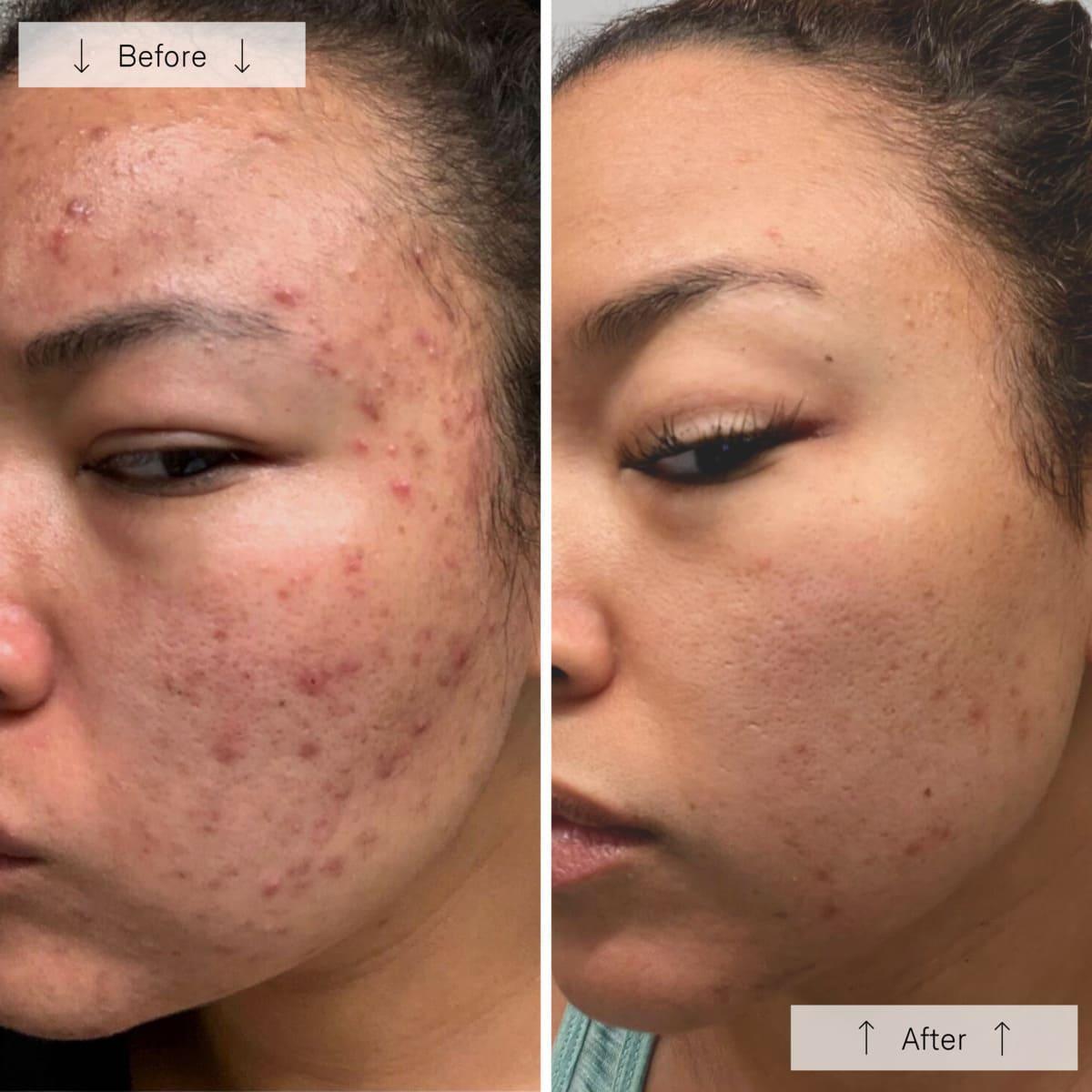 Light Therapy for Face, Facial Skincare