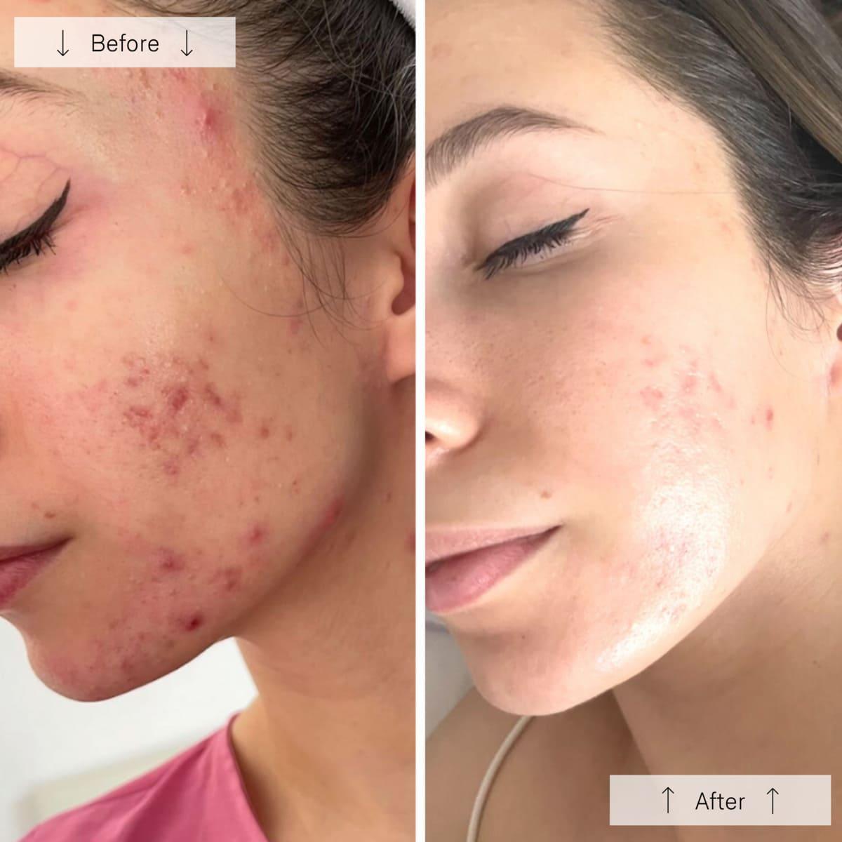Light Therapy for Face, Facial Skincare