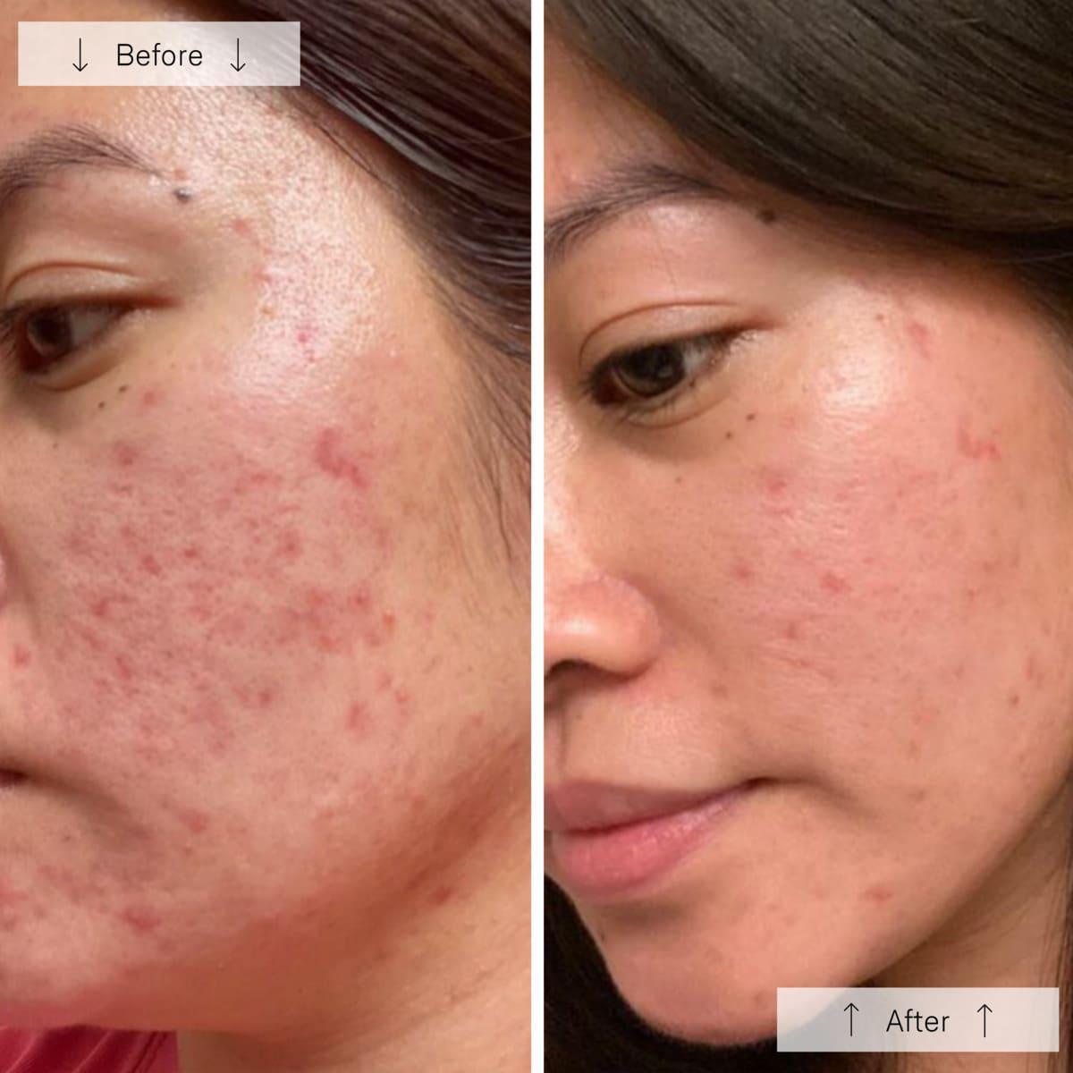 Light Therapy for Face, Facial Skincare