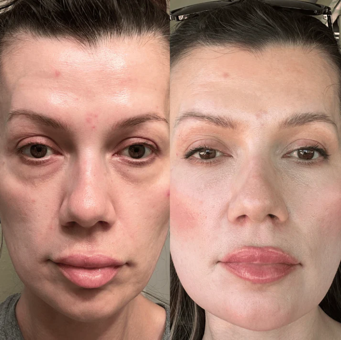Under-Eye Red Light Therapy