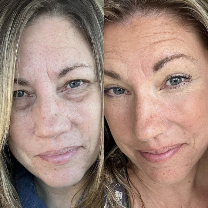 Under-Eye Red Light Therapy