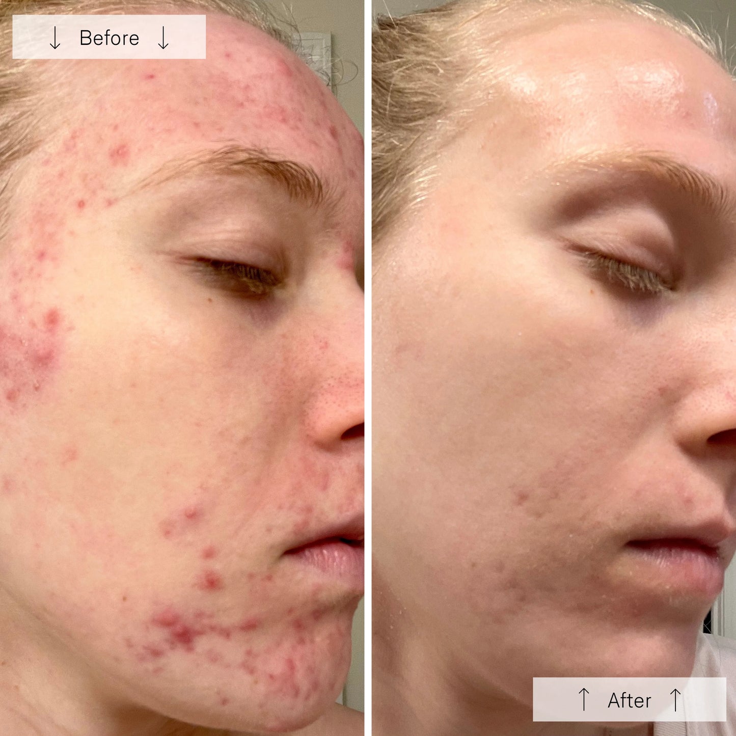 Light Therapy for Face, Facial Skincare