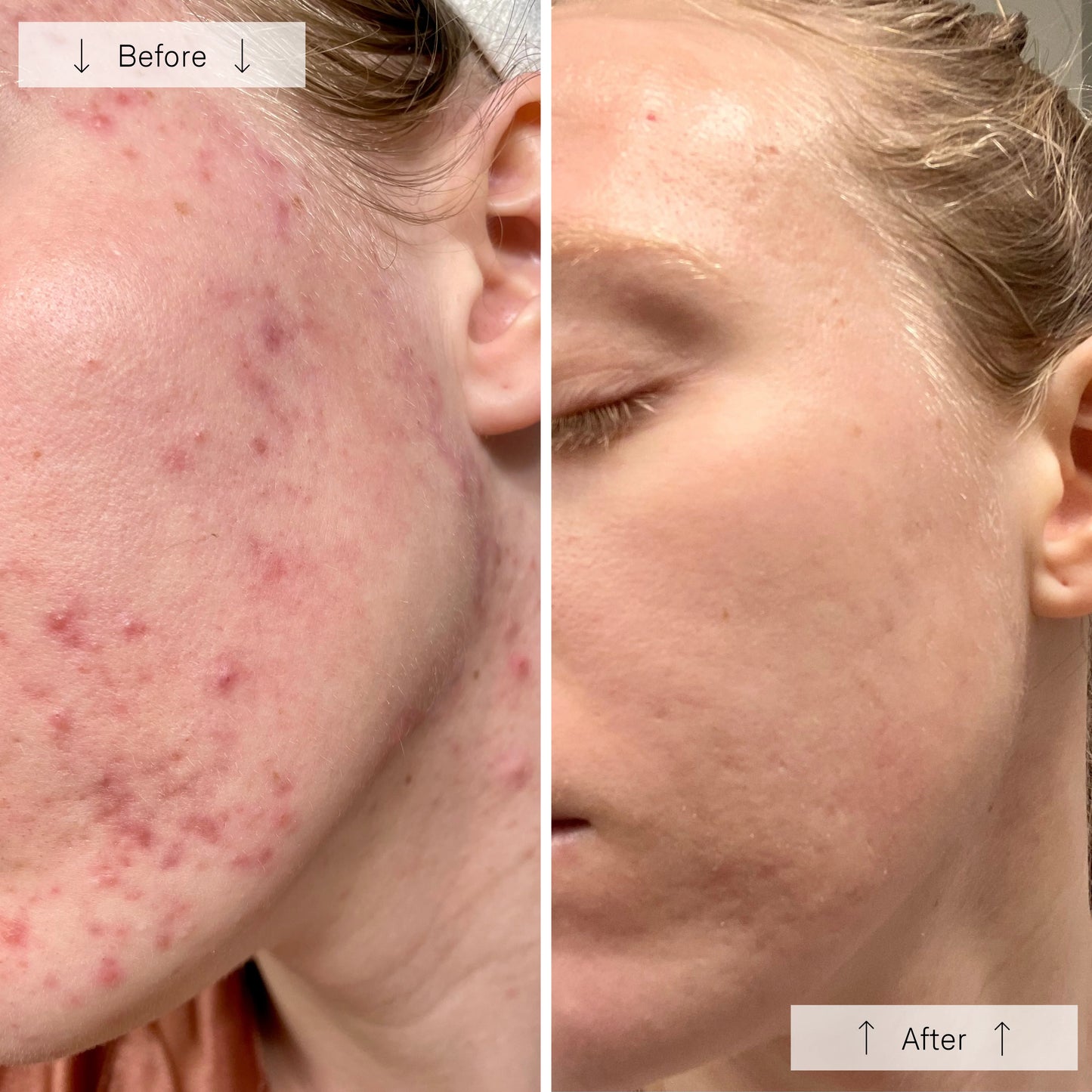 Light Therapy for Face, Facial Skincare