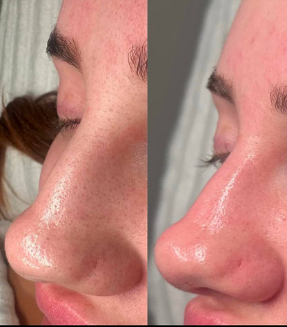 Glow & Go Face Skin Blackhead Remover Spatula