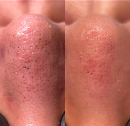 Glow & Go Face Skin Blackhead Remover Spatula