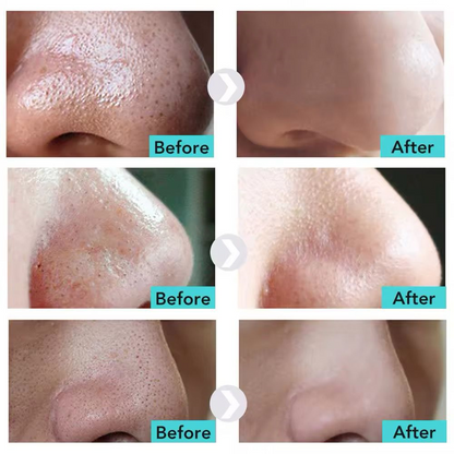 Glow & Go Face Skin Blackhead Remover Spatula